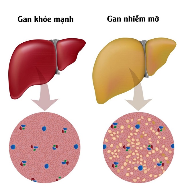 Bệnh gan nhiễm mỡ có nguy hiểm không và những biểu hiện cụ thể