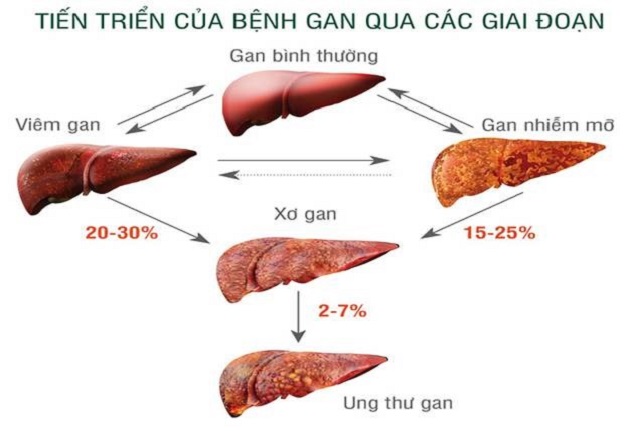 Bệnh gan nhiễm mỡ có nguy hiểm và cách khắc phục