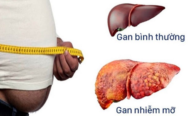 Bệnh gan nhiễm mỡ: Đặc điểm, nguy cơ biến chứng