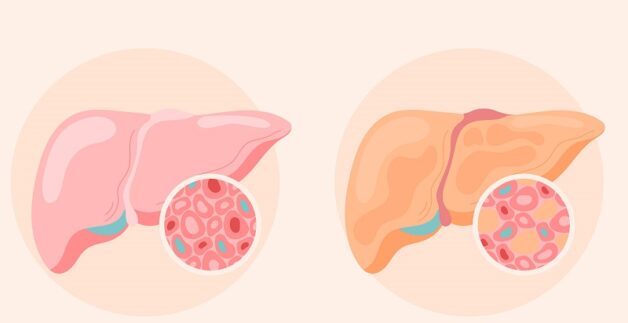 Bệnh gan nhiễm mỡ là gì, nguyên nhân và cách điều trị