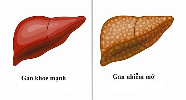 Bệnh gan nhiễm mỡ: nguyên nhân, triệu chứng và cách chẩn đoán