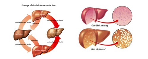 Bệnh gan nhiễm mỡ và cách điều trị