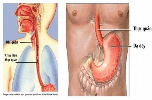 Bệnh giãn tĩnh mạch thực quản và những điều cần biết