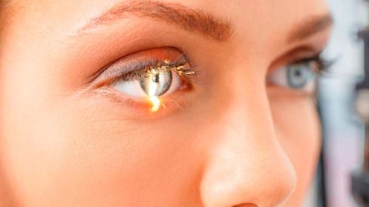 Bệnh Glaucoma cấp: Triệu chứng, chẩn đoán và cách điều trị