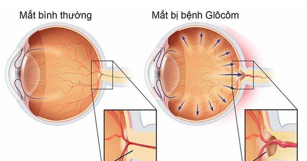 Bệnh glocom có chữa được không hay mù vĩnh viễn?