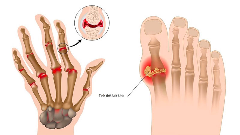 Bệnh gout có thể chữa khỏi không và cách điều trị