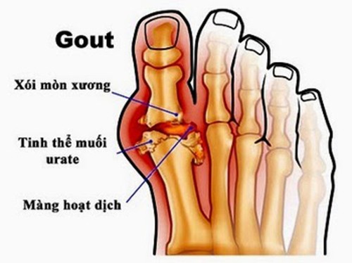 Bệnh gout đau ở đâu?