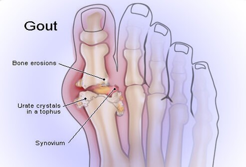 Bệnh gout là gì?biểu hiện sưng tấy đỏ