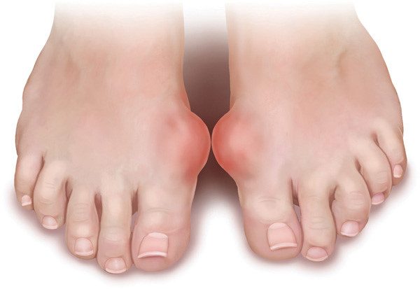 Bệnh Gout là gì?Triệu chứng của căn bệnh này như thế nào