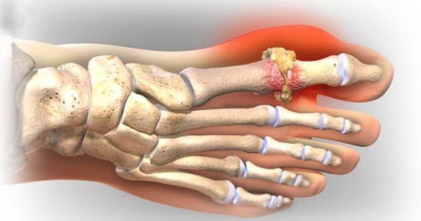 Bệnh Gout là gì?Triệu chứng của căn bệnh này như thế nào