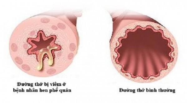 Bệnh hen phế quản dị ứng là gì?