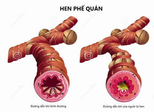 Bệnh hen phế quản nên ăn gì? Để bệnh không phát triển nặng hơn