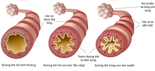 Bệnh hen phế quản: Nguyên nhân và cách kiểm soát