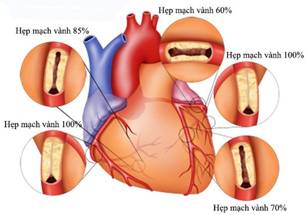 Bệnh hẹp động mạch vành: biểu hiện, mức độ nguy hại và cách điều trị