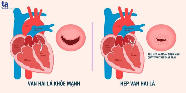 Bệnh hẹp van 2 lá: tìm hiểu nguyên nhân, triệu chứng, cách kiểm soát