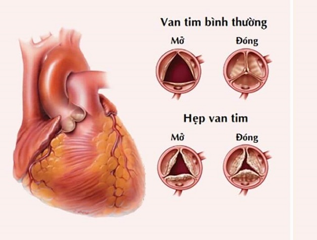 Bệnh hẹp van tim có nguy hiểm không và cách điều trị 