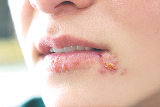 Bệnh herpes có chữa khỏi được không và cách chăm sóc