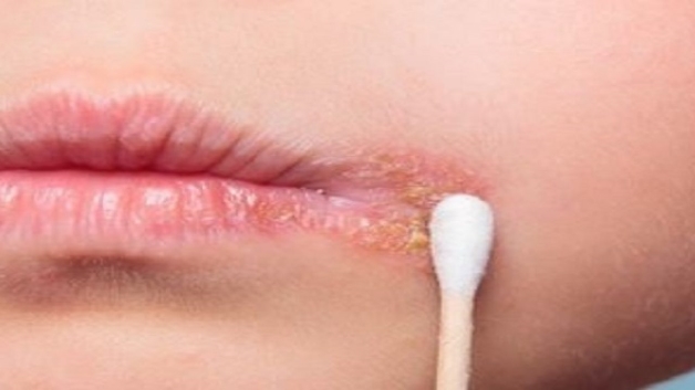 Bệnh herpes có chữa khỏi được không và cách chăm sóc