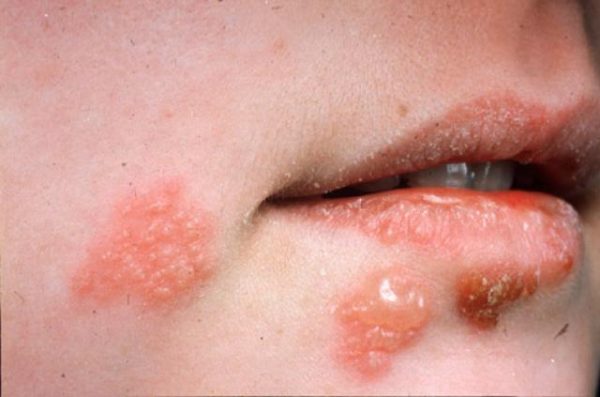 Bệnh Herpes đơn dạng là gì? không phải ai cũng biết