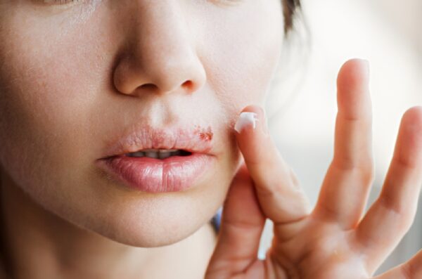 Bệnh herpes môi kiêng ăn gì để hạn chế viêm loét