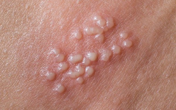 Bệnh Herpes sinh dục (mụn rộp sinh dục) là gì?bệnh da liễu