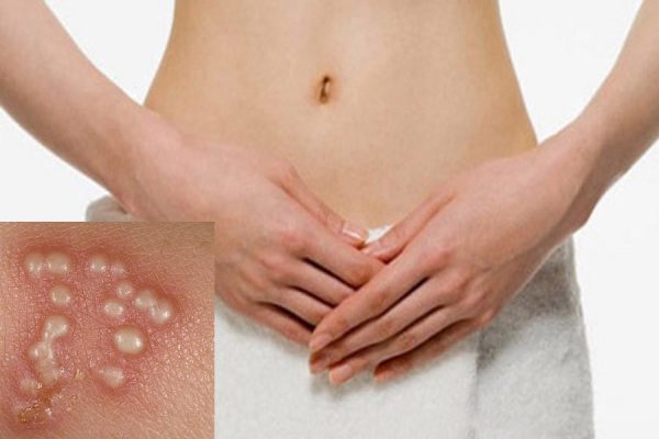 Bệnh Herpes sinh dục (mụn rộp sinh dục) là gì?bệnh da liễu