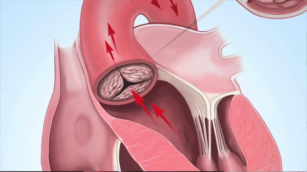 Bệnh hở van động mạch phổi: Làm thế nào để nhận biết và điều trị?