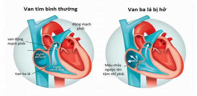 Bệnh hở van tim 3 lá 1/4 có nguy hiểm không?