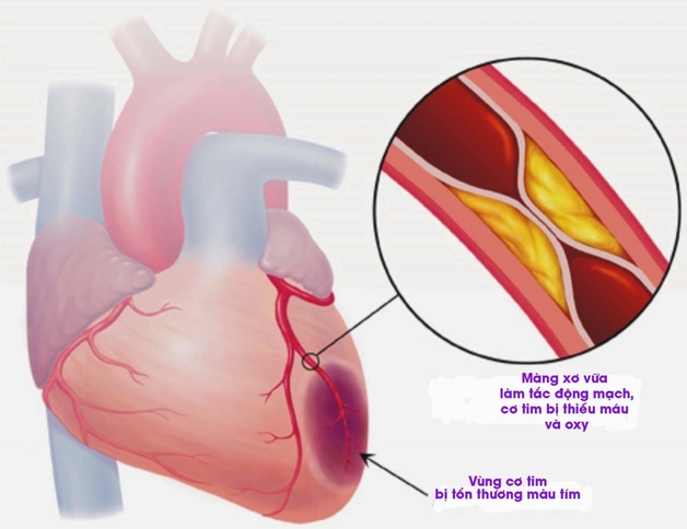 Bệnh hở van tim 3 lá 1/4 có nguy hiểm không?