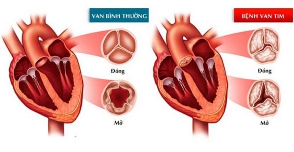 Bệnh hở van tim có chữa được không?