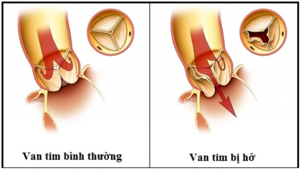 Bệnh hở van tim có nguy hiểm không? Xử trí như thế nào?