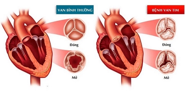 Bệnh hở van tim và những điều bạn cần phải biết