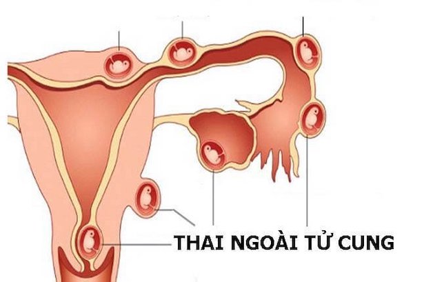 Bệnh học chửa ngoài tử cung: Nguyên nhân và cách điều trị