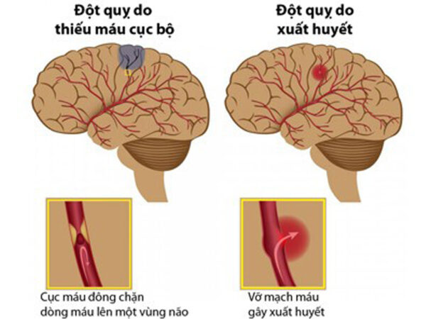 Bệnh học tai biến mạch máu não và các yếu tố nguy cơ