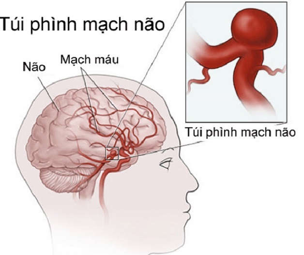 Bệnh học tai biến mạch máu não và các yếu tố nguy cơ