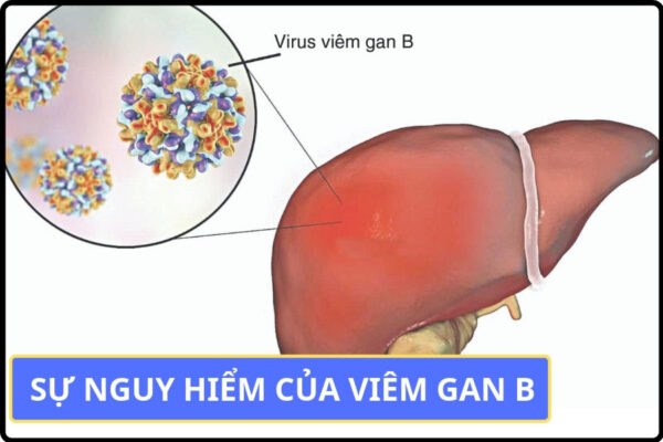 Bệnh học xơ gan: nguyên nhân, chẩn đoán và điều trị