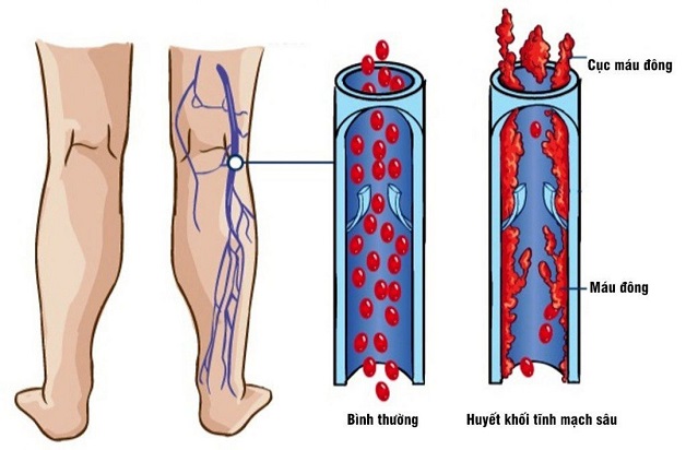 Bệnh huyết khối tĩnh mạch sâu: Nguyên nhân, biến chứng