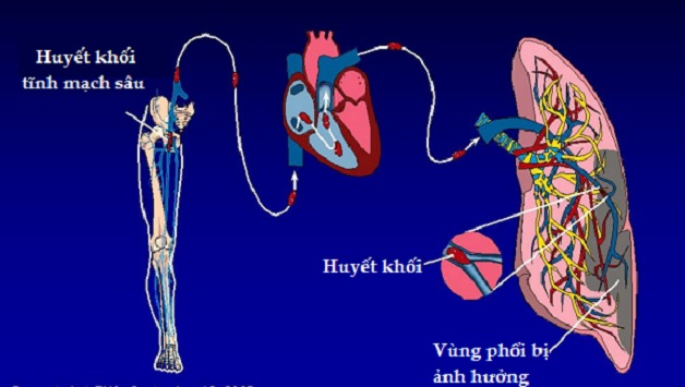 Bệnh huyết khối tĩnh mạch sâu: Nguyên nhân, biến chứng