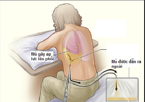 Bệnh lao màng phổi có nguy hiểm không?