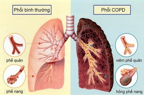 Bệnh lao phổi nguy hiểm như thế nào?