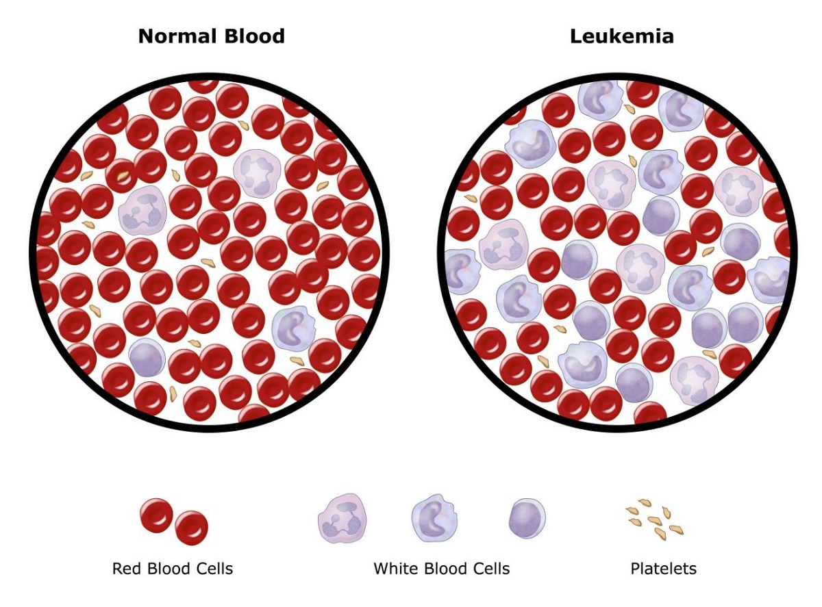 Bệnh Leukemia là gì? Nguyên nhân, cách chẩn đoán và điều trị