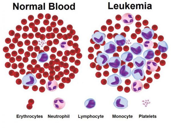 Bệnh Leukemia là gì? Nguyên nhân, cách chẩn đoán và điều trị