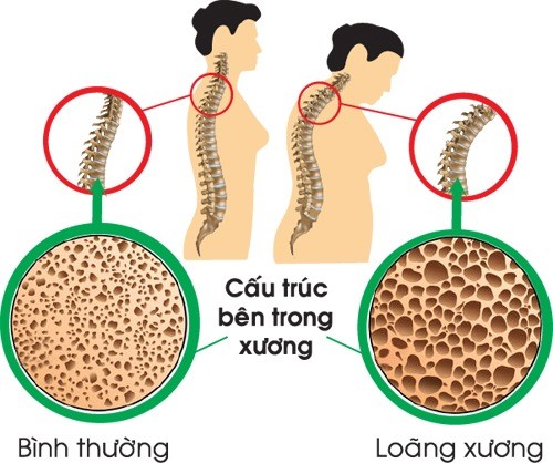 Bệnh loãng xương là gì? gây ra những hậu quả