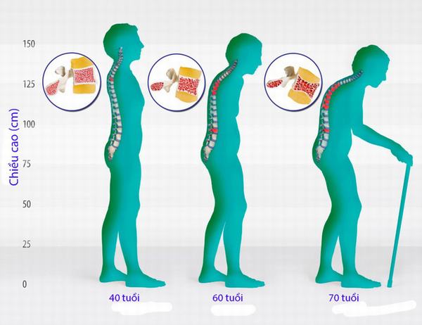 Bệnh loãng xương ở phụ nữ mãn kinh và cách khắc phục