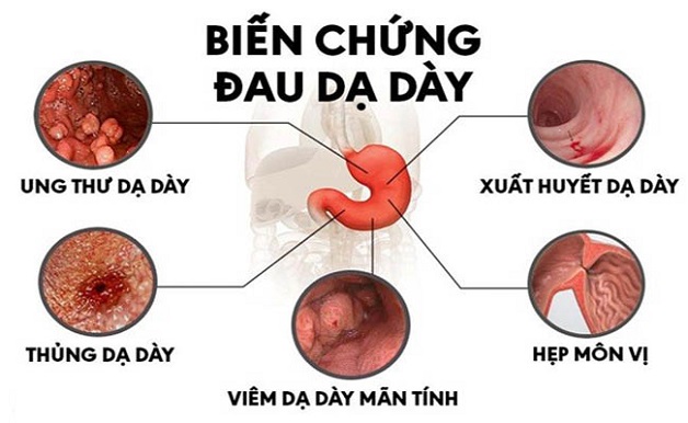 Bệnh loét dạ dày và những điều cần quan tâm