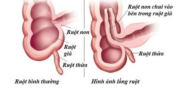 Bệnh lồng ruột ở trẻ: nguyên nhân mắc bệnh và cách điều trị 