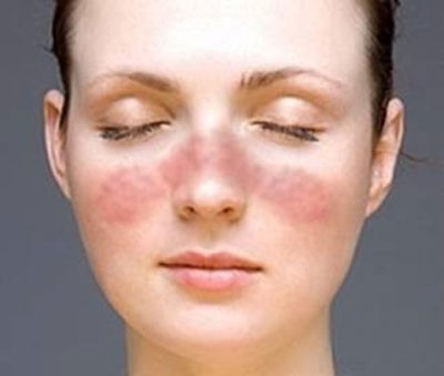 Bệnh lupus ban đỏ có di truyền không?