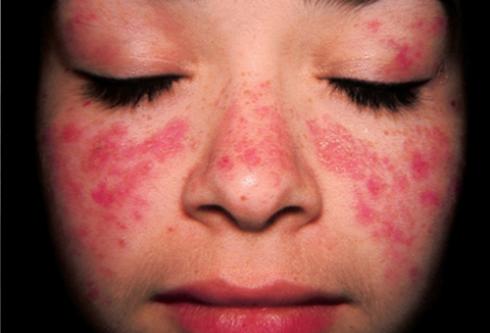 Bệnh lupus ban đỏ có di truyền không?