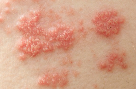 Bệnh lupus ban đỏ có nguy hiểm không?