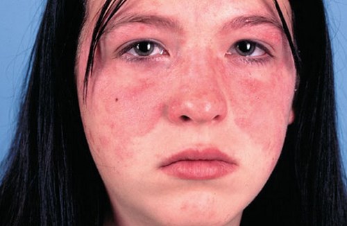 Bệnh lupus ban đỏ có nguy hiểm như thế nào?